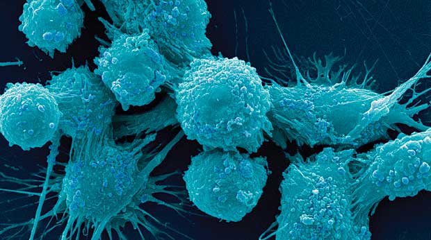 Prostate cancer cells. (Image by Dr. Gopal Murti/Visuals Unlimited, Inc.)